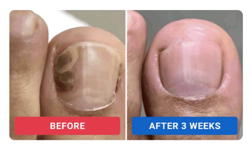 Orivelle Nail Fungus Pen review by Rachel M.